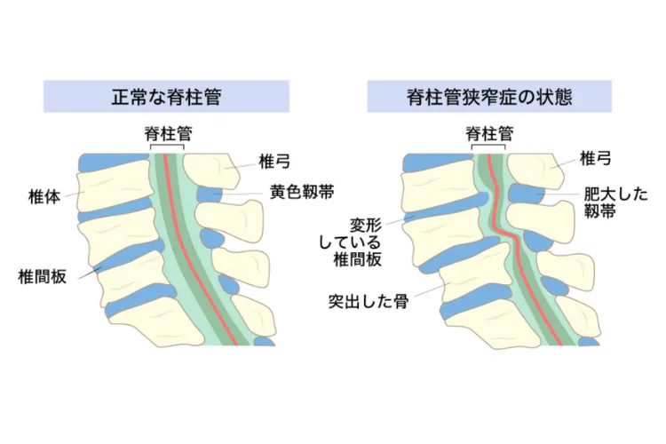 脊柱管狭窄症について図説